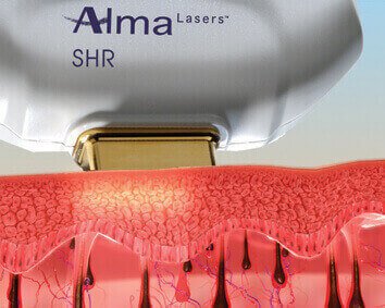 Alma Laser: SHR permanent hair removal
